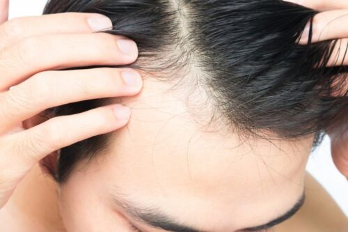penyebab rambut rontok