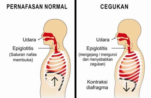 penyebab cegukan